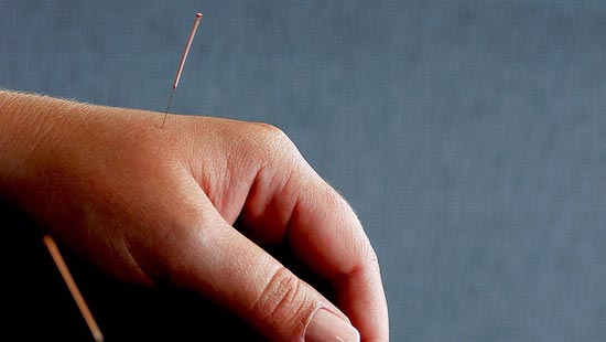 A hand with two accupuncture needles stuck in it